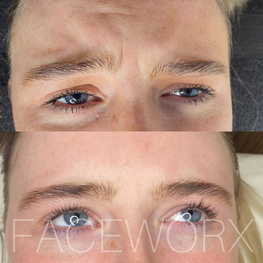 anti-wrinkle injections in liverpool