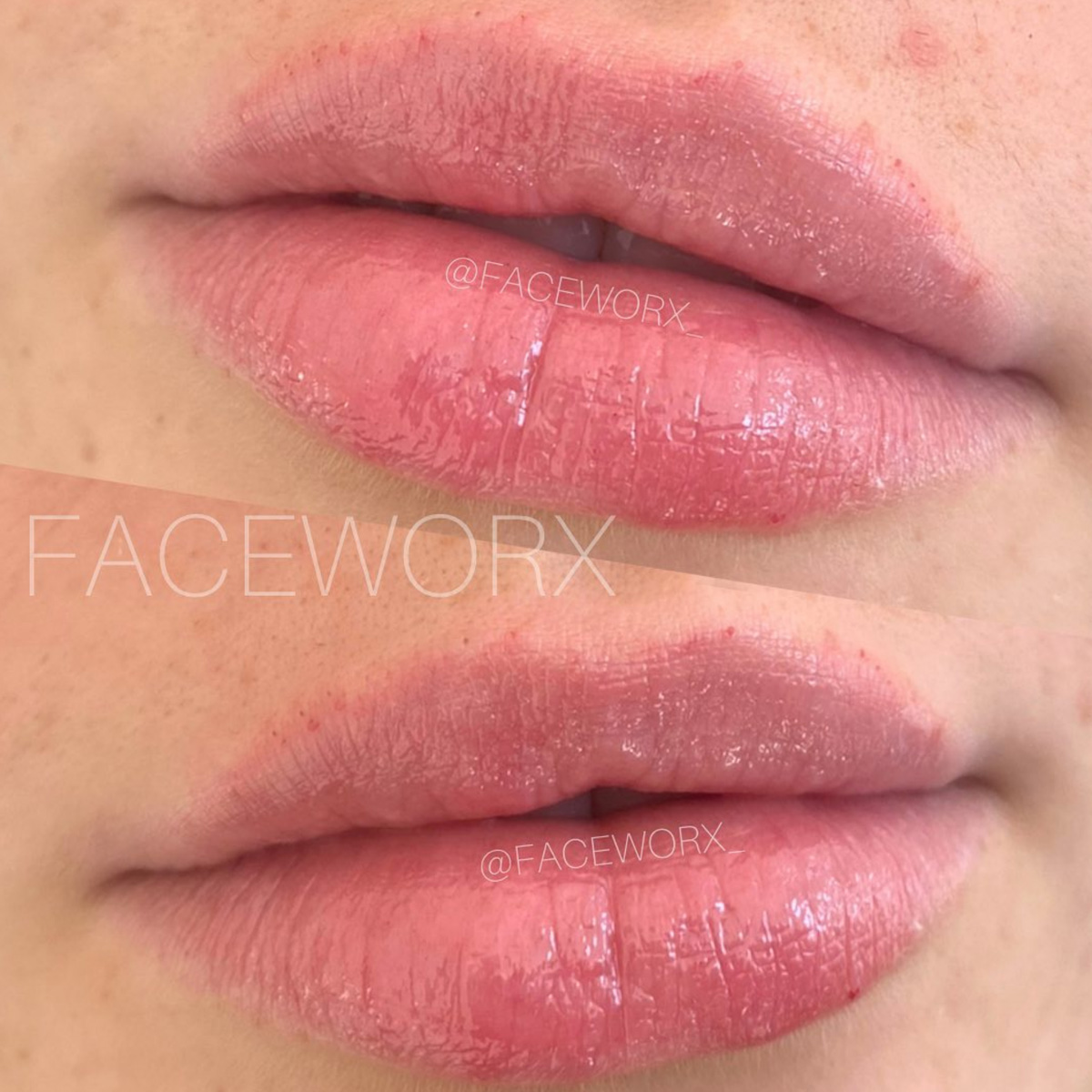 lip fillers at faceworx